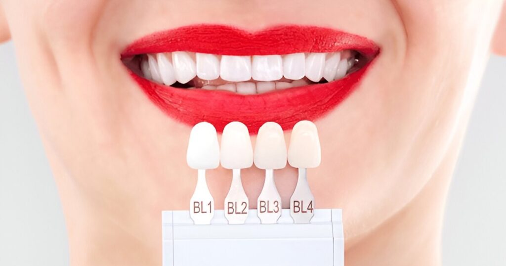 How Long Veneers Last