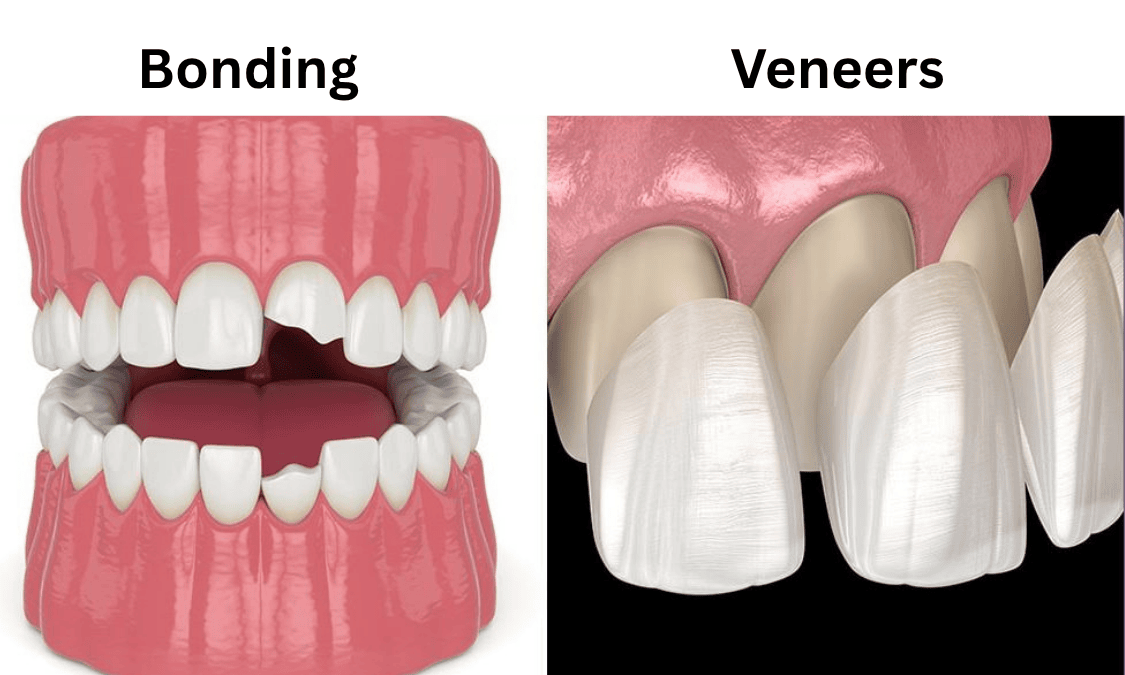 Veneers vs Bonding
